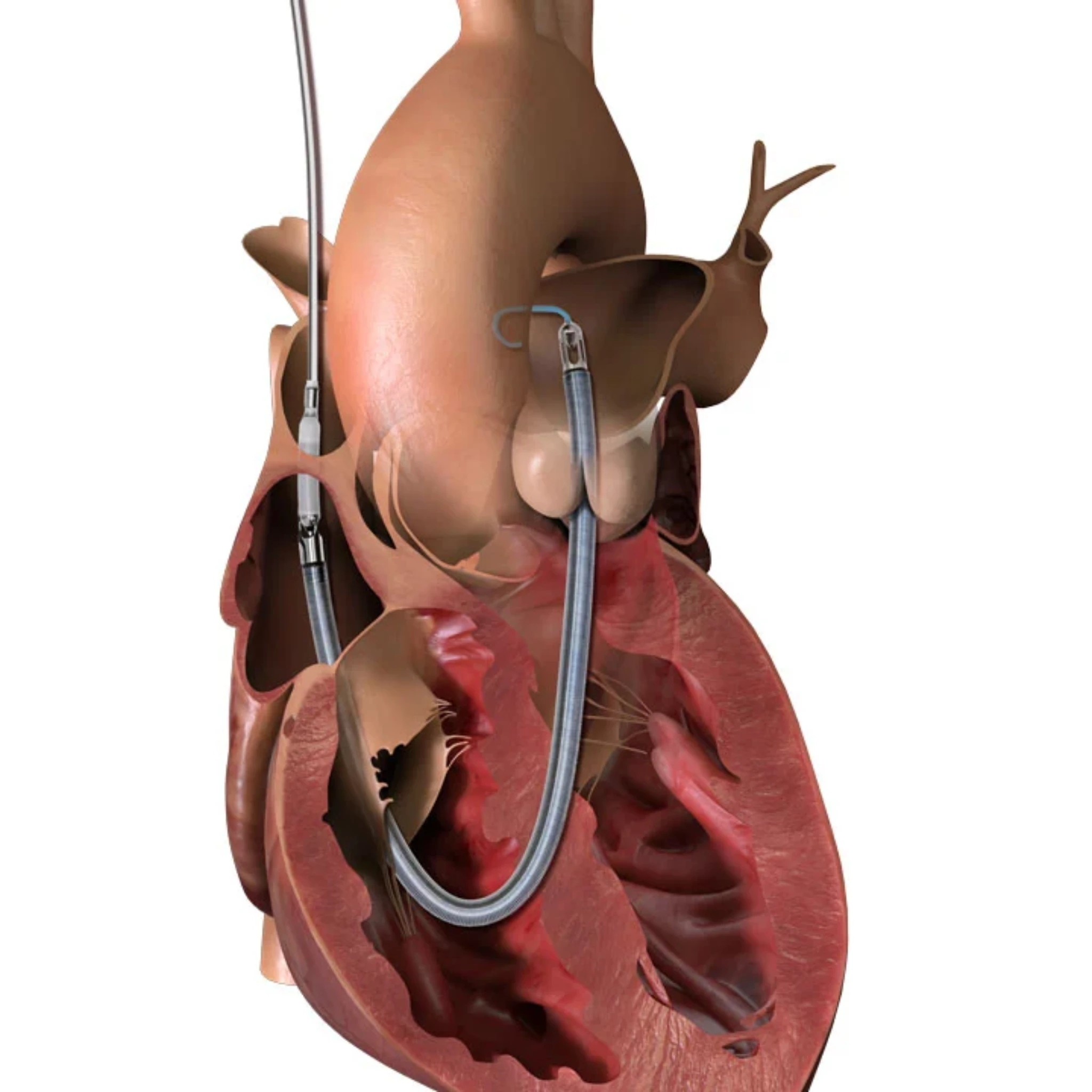 Abiomed Impella RP Flex Introducer Kit