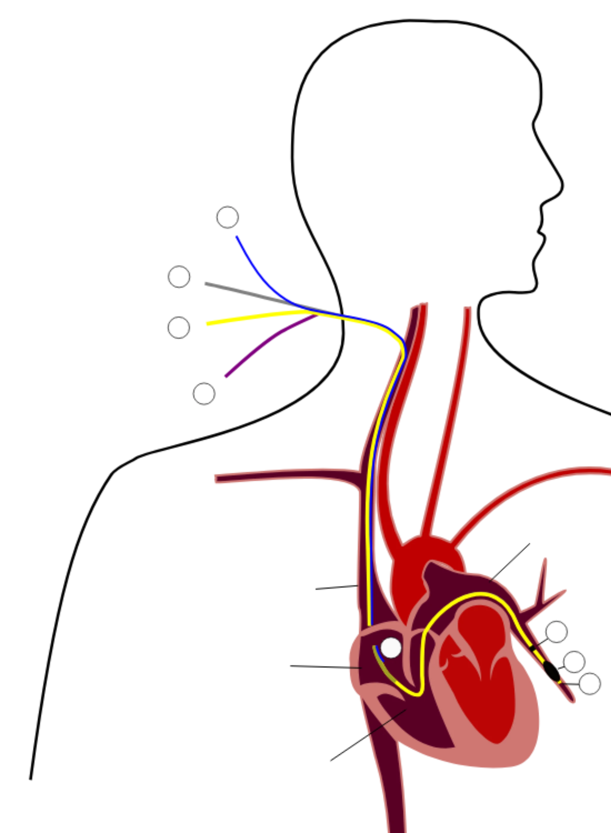 Swan-Ganz Catheter