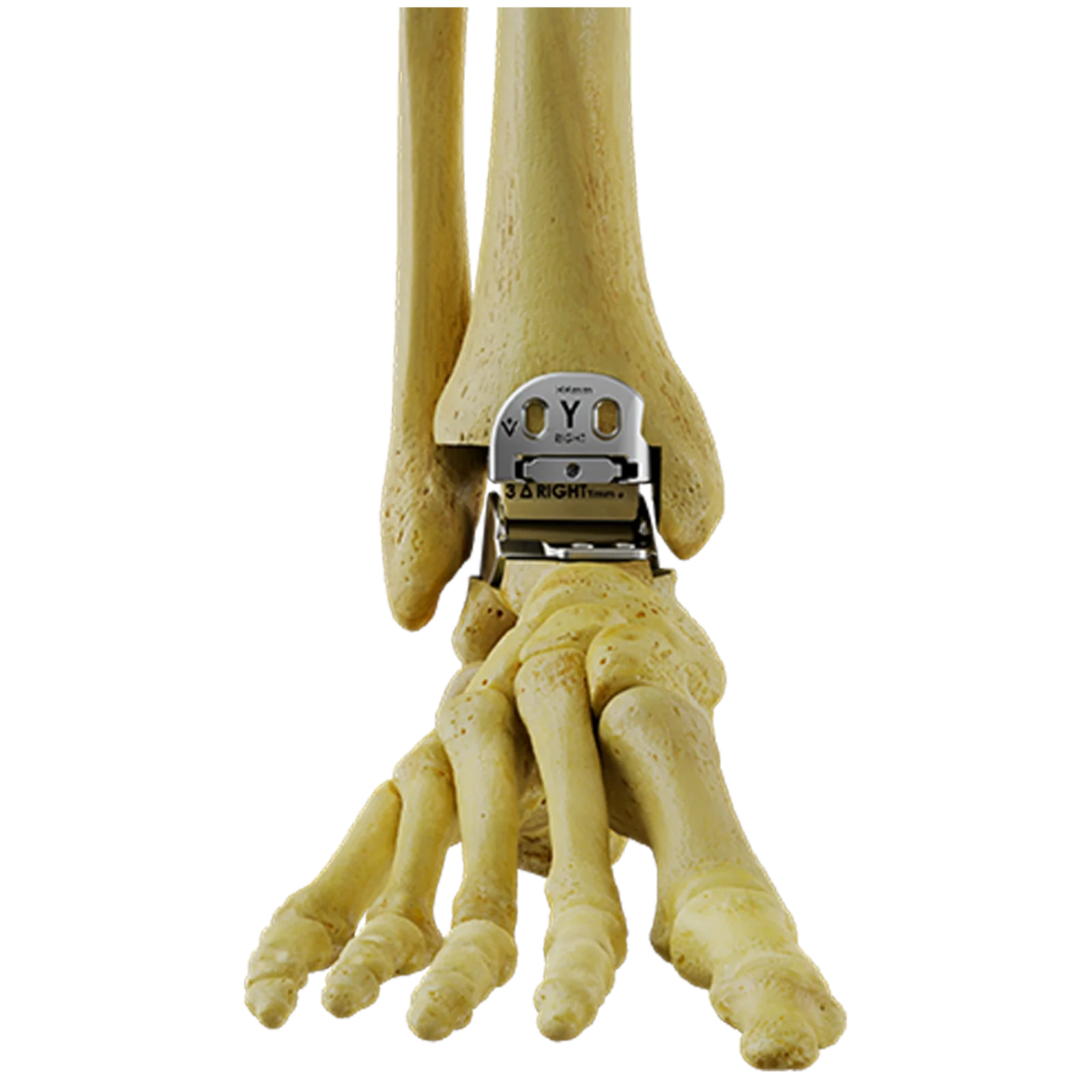 Hintermann Series Talar Implant