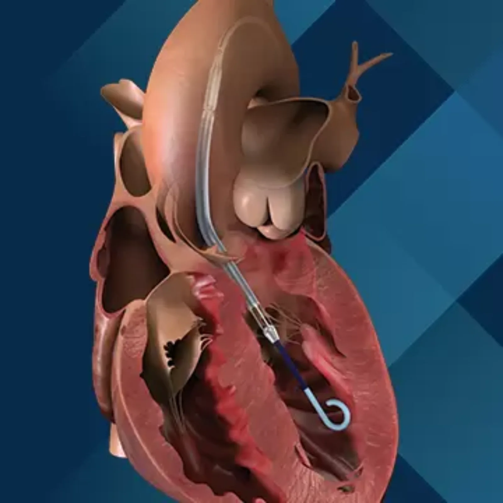 Impella CP Set with SmartAssist