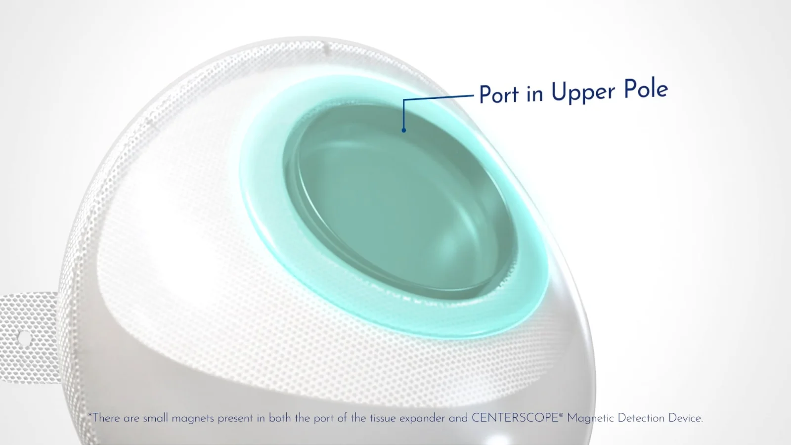 Artoura Breast Tissue Expanders