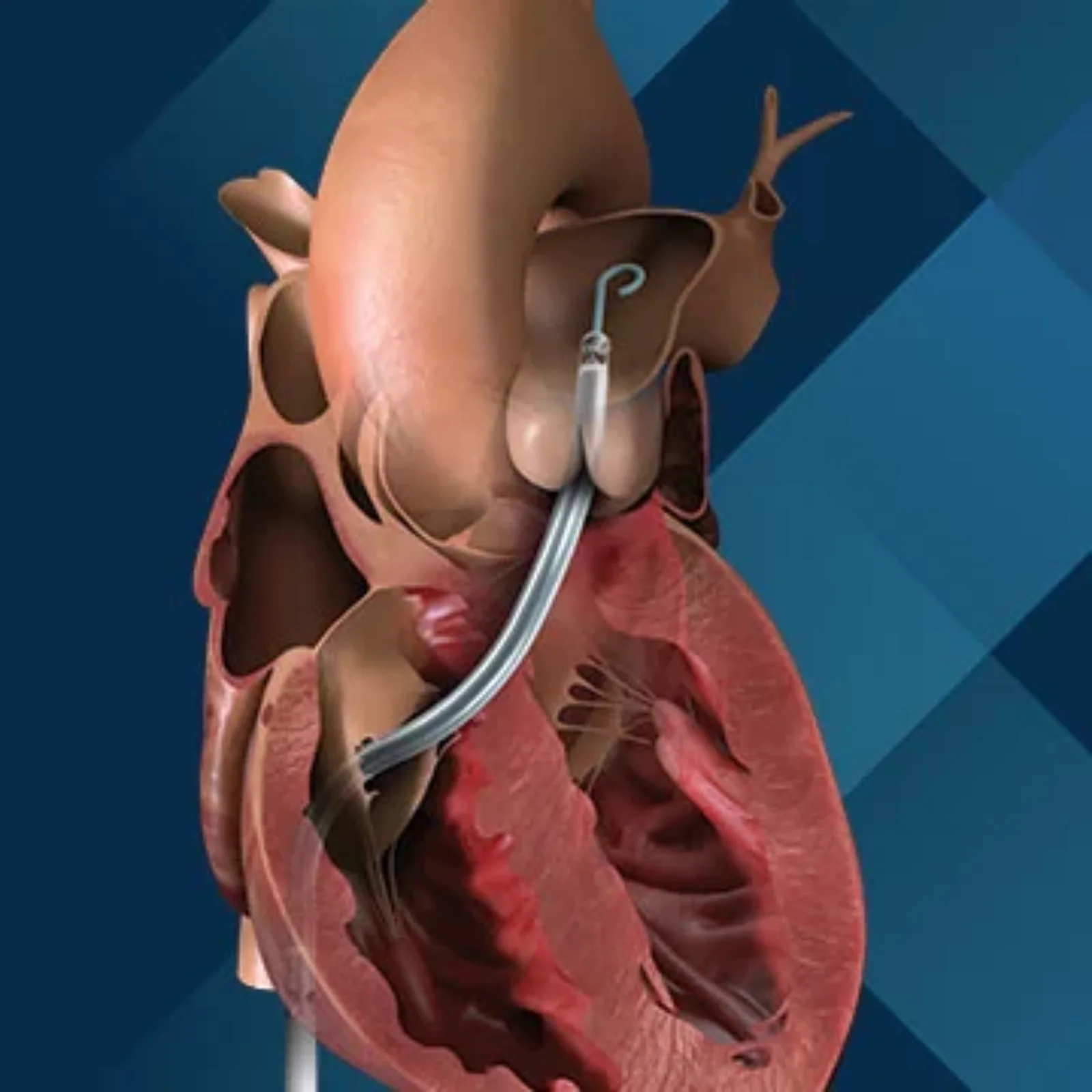 Impella RP Flex with SmartAssist