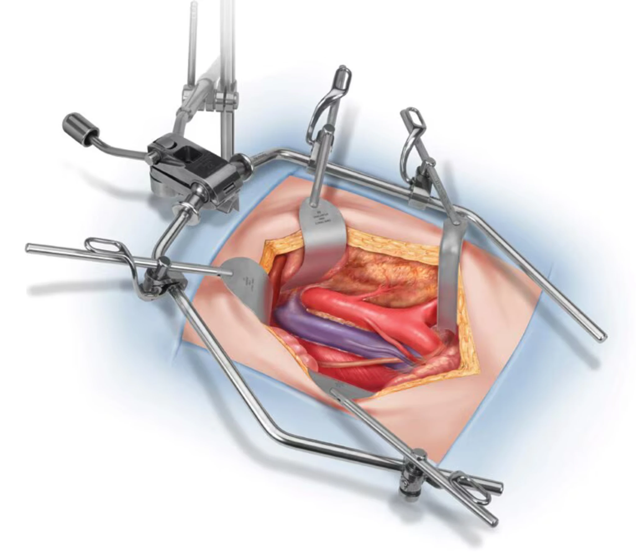 OmniTract Surgical Retractor System