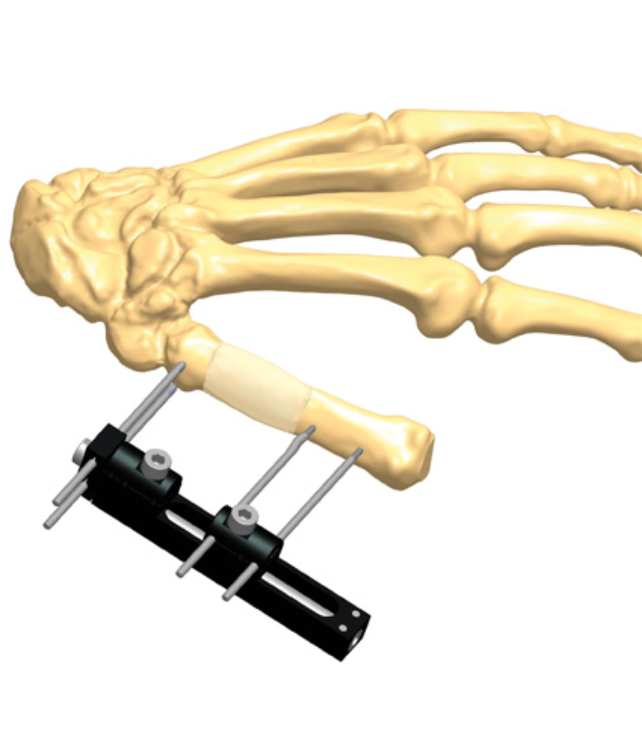Orthofix MINIRAIL External Fixation Device