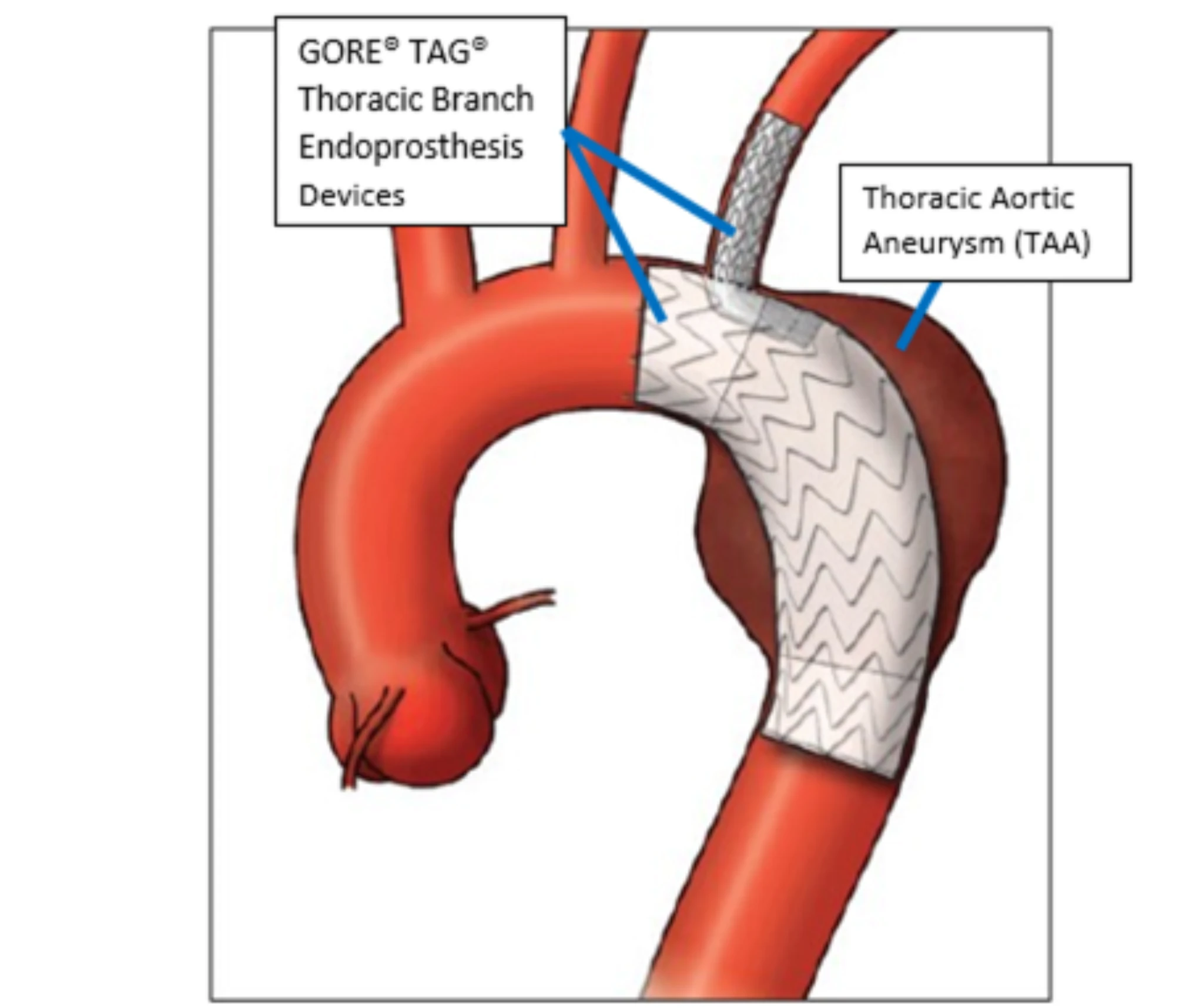 Gore TAG Thoracic Branch Endoprosthesis Side Branch Component