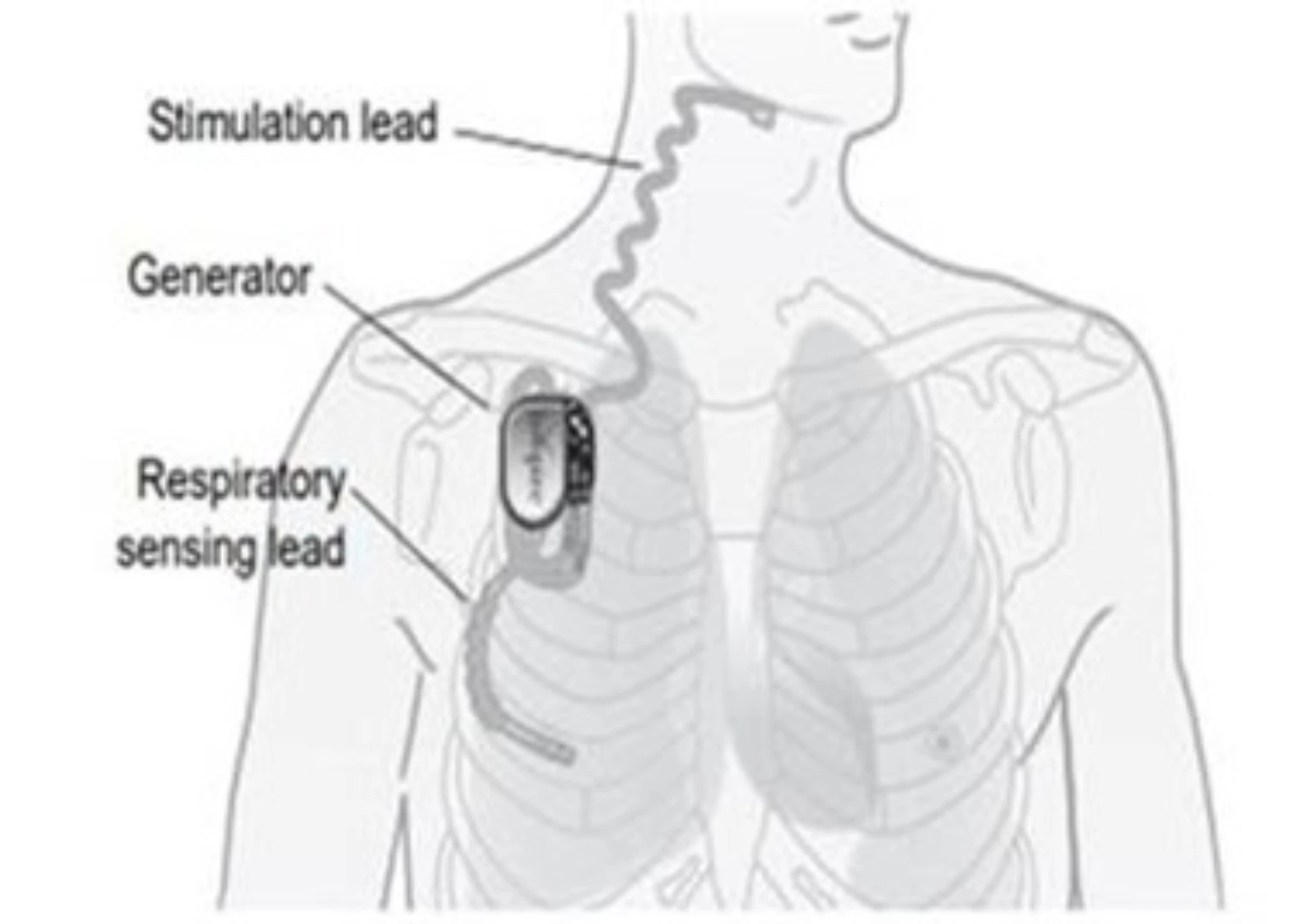 Inspire Respiratory Sensing Lead