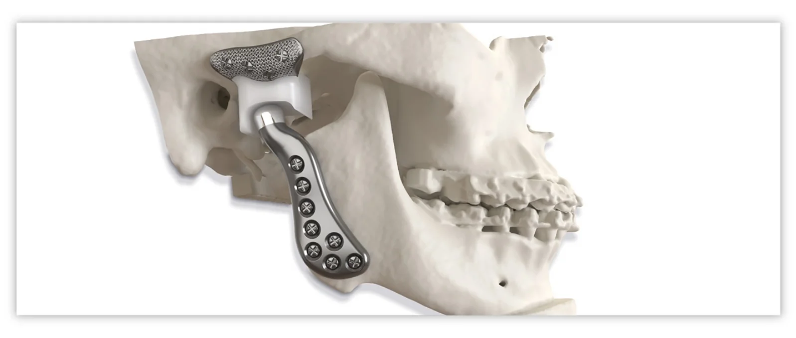 TMJ Bilateral Implants