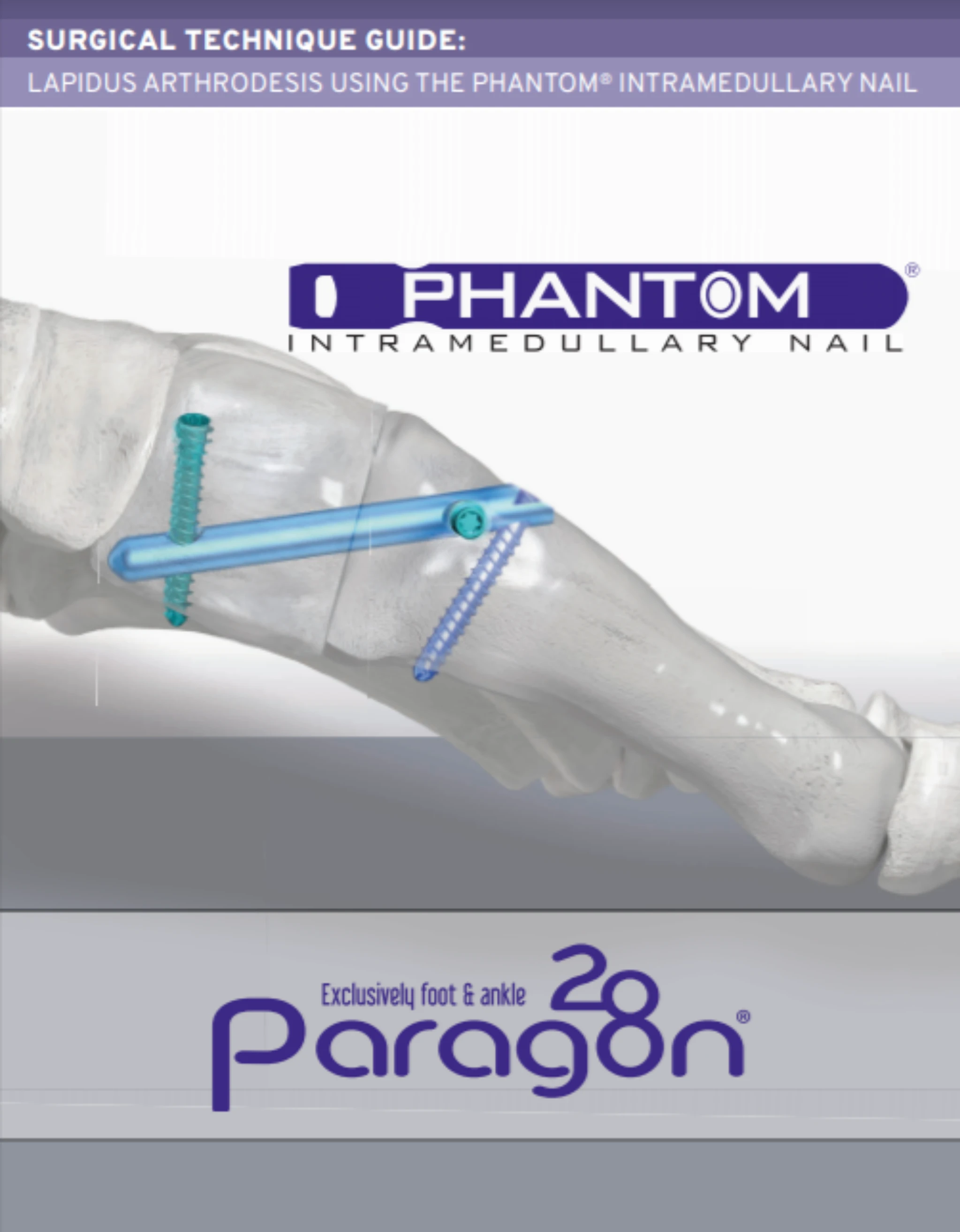 Paragon 28 Phantom Intramedullary Nail System Guide Rod