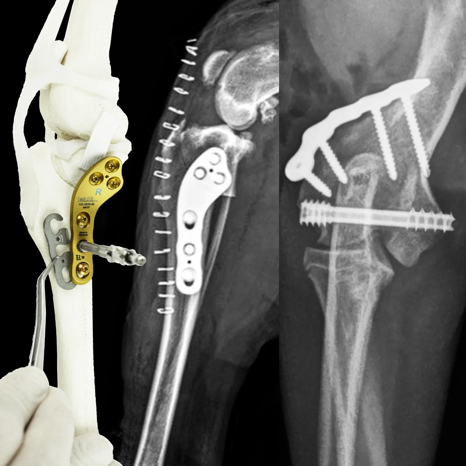 I.T.S. Headless Compression Screw System
