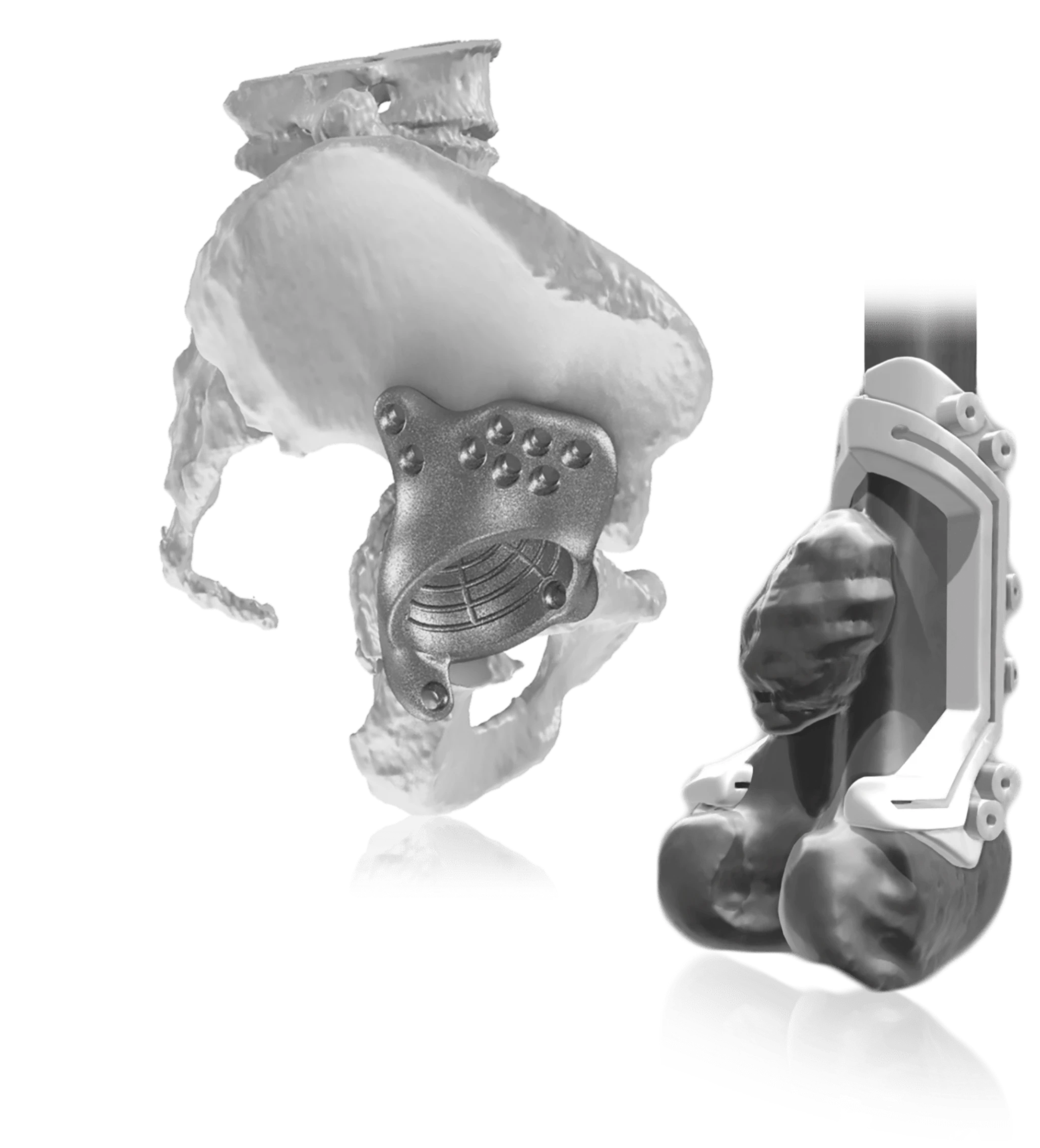 Onkos Surgical My3D Personalized Pelvic Implant