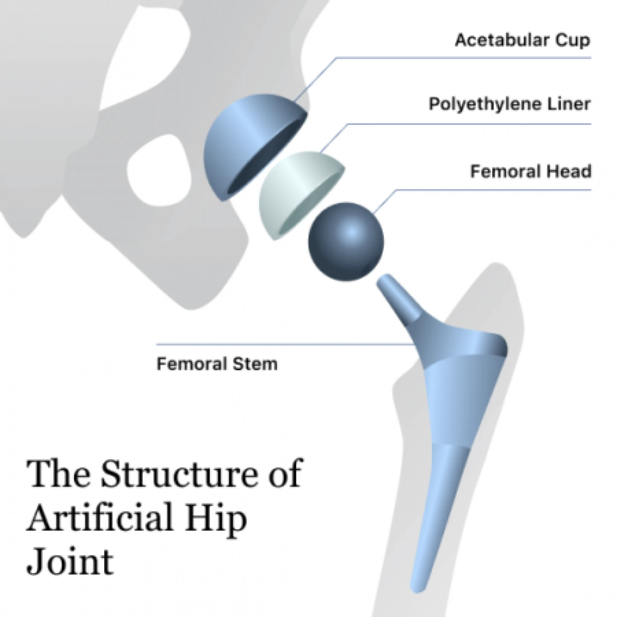 Howmedica Osteonics Orthopaedic Implant Components